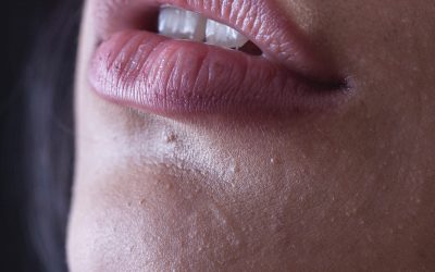 Aumento de labios en Sevilla