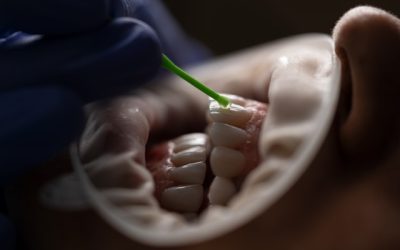 ¿Qué son los Implantes Dentales en Sevilla? Descubre esta innovadora técnica dental